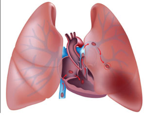 Imagem ilustrativa de uma embolia pulmonar