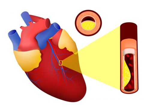 Imagem ilustrativa de um infarto agudo do miocárdio