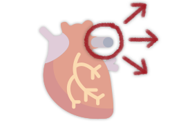 estenose-aortica