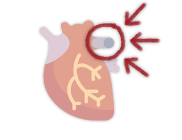 insuficiencia-aortica