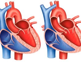 Ilustração de um coração com estenose aórtica