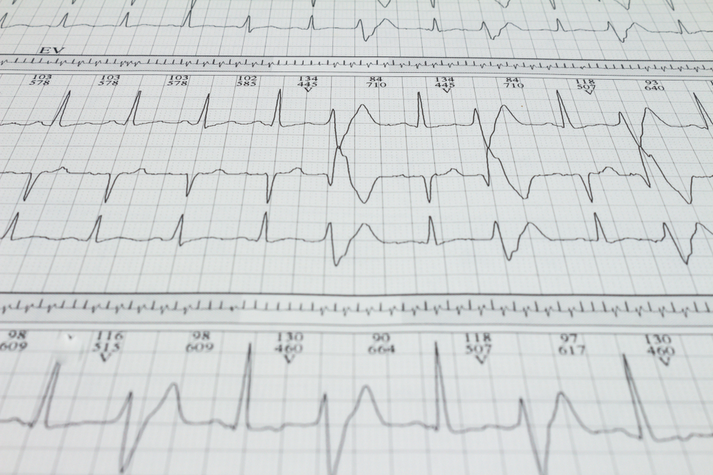 Registro de exames de uma extra-sístole ventricular