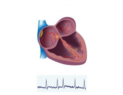 Coração com fibrilação atrial